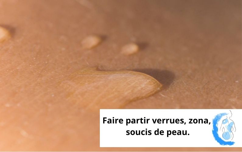 Faire partir verrues, zona, soucis de peau